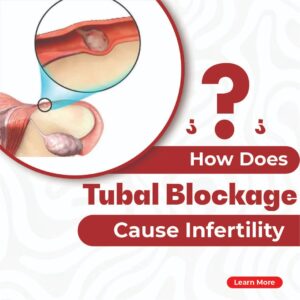 How Does Fallopian Tube Blockage Lead to Infertility?